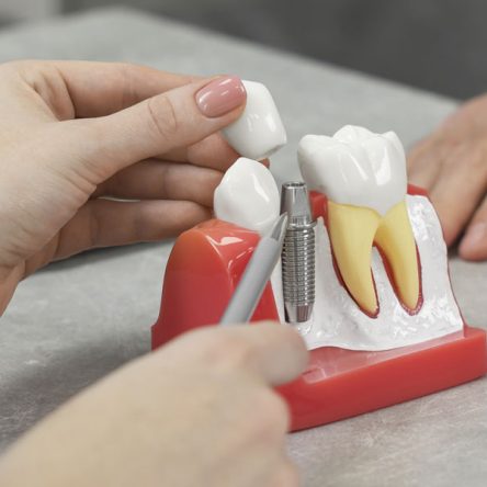 What Happens During a Dental Implant Procedure?